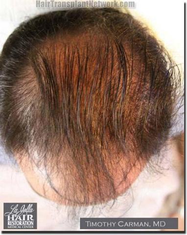 Hair restoration procedure results