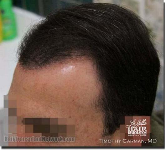 Hair restoration procedure results