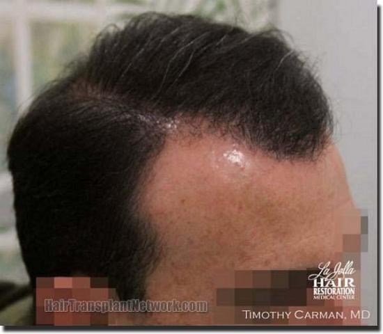 Hair restoration procedure results