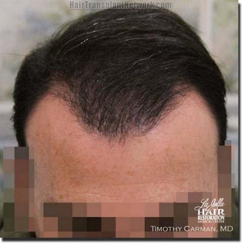 Hair restoration procedure results