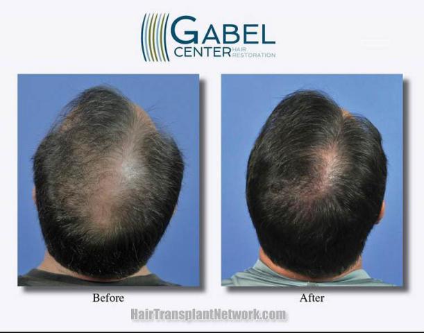 Hair replacement surgery before and after images