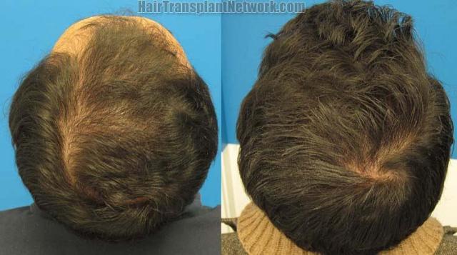 Hair restoration procedure before and after pictures