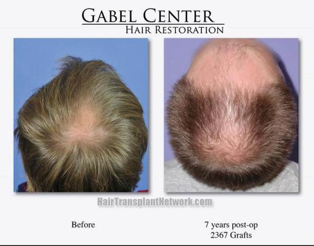 Hair transplant surgery before and after images