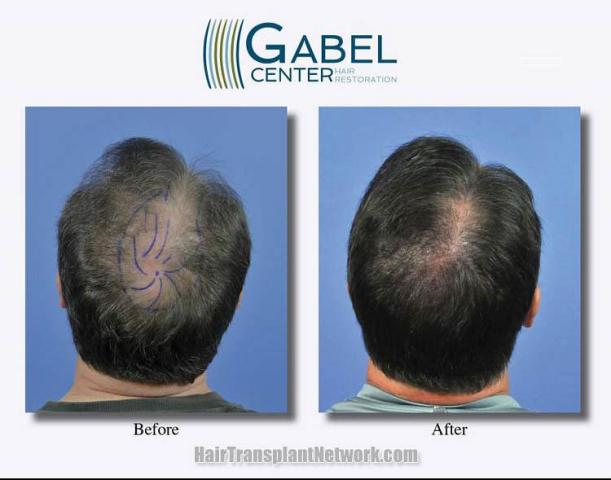 Surgical hair transplantation result photographs