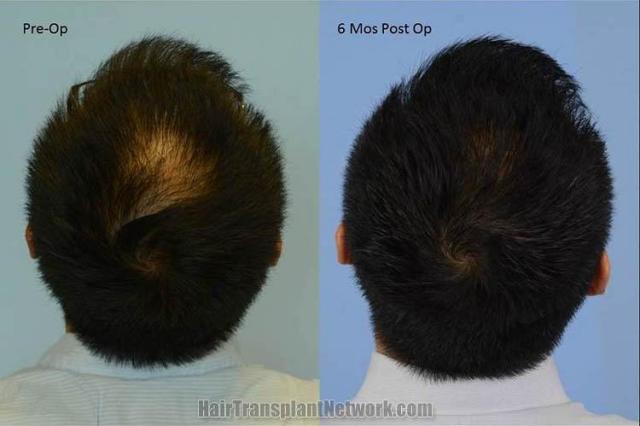 Hair transplantation surgery before and after pictures