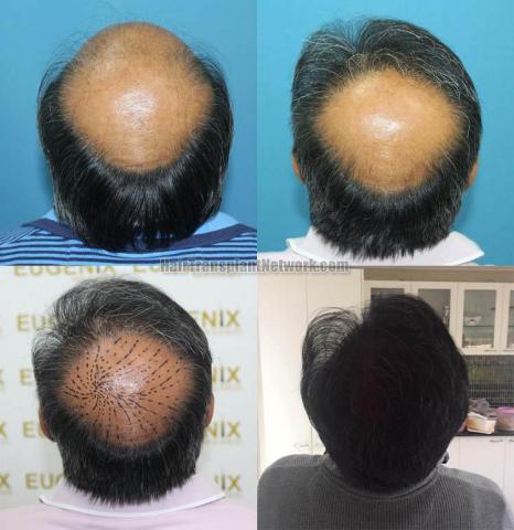 Hair restoration procedure before and after images