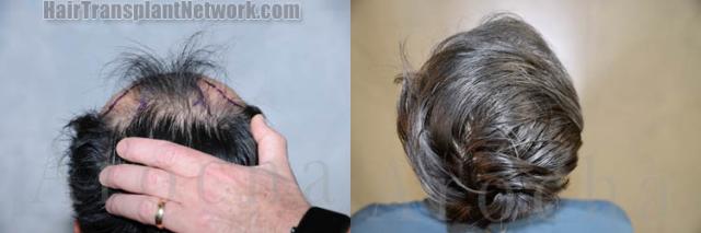 Surgical hair transplantation result photographs