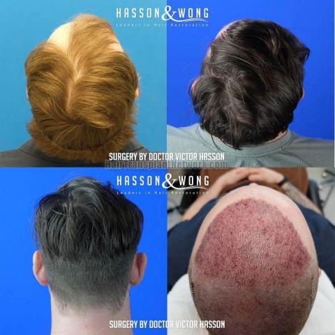 Surgical hair transplantation result photographs