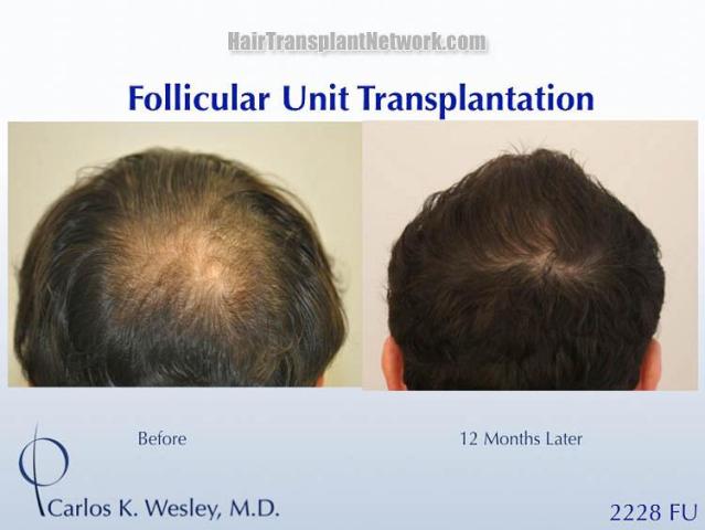 Hair transplantation surgery before and after photos