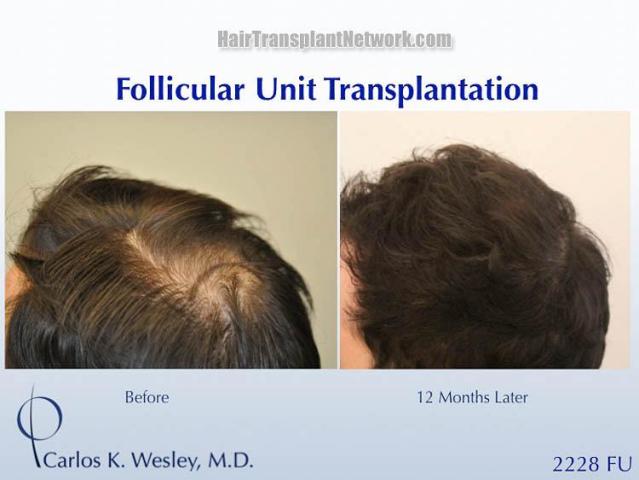 Hair transplantation surgery before and after pictures