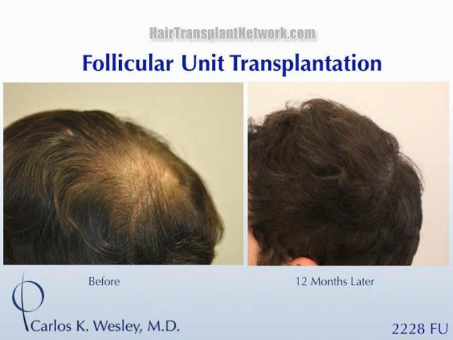 Hair restoration procedure before and after pictures