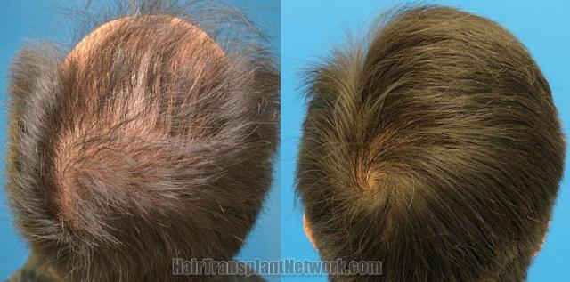 Hair transplantation surgery before and after pictures