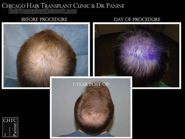 Hair restoration procedure before and after pictures