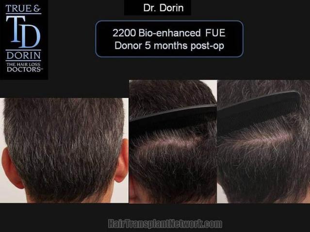 Hair restoration procedure before and after pictures