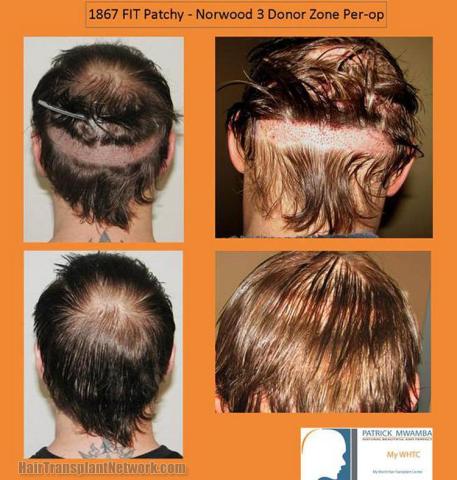 Hair transplant surgery before and after pictures