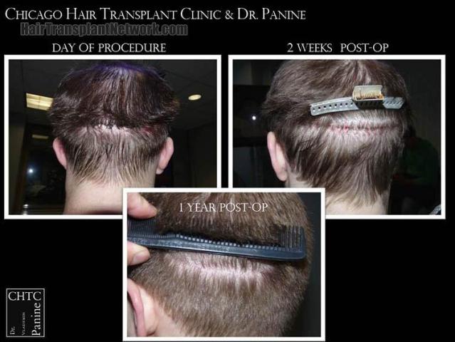 Hair restoration surgery after photos