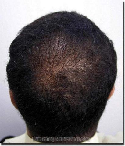 Hair restoration procedure results