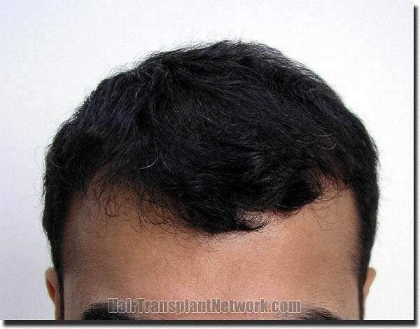 Hair restoration procedure results