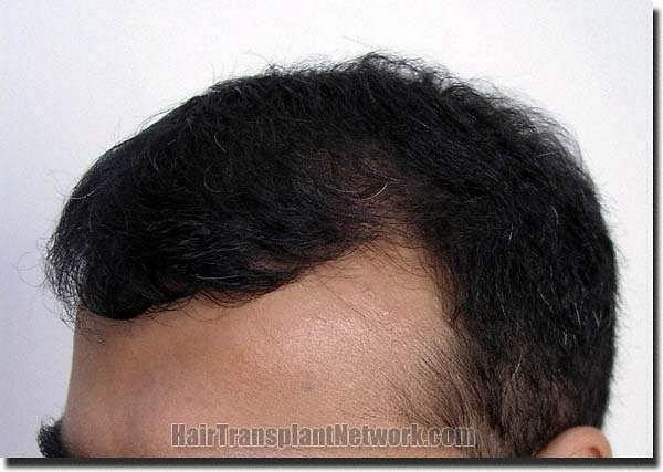 Hair restoration procedure results