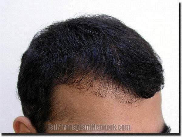 Hair restoration procedure results