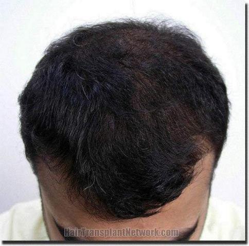 Hair restoration procedure results