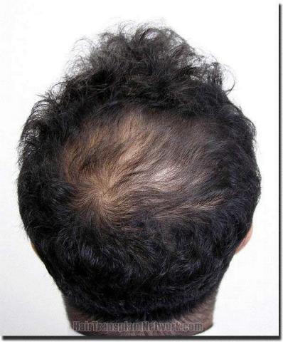 Hair restoration procedure results