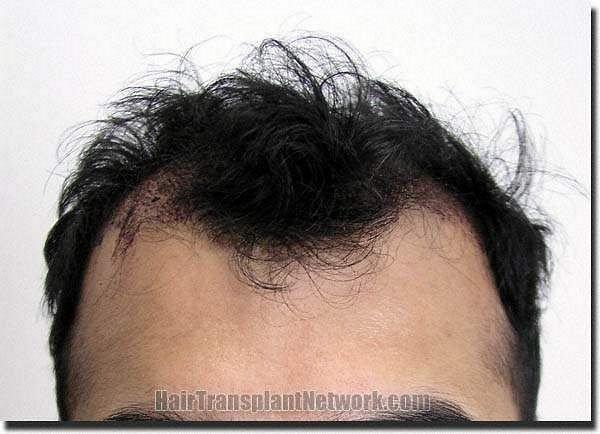 Hair restoration procedure results