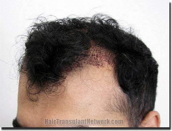 Hair restoration procedure results