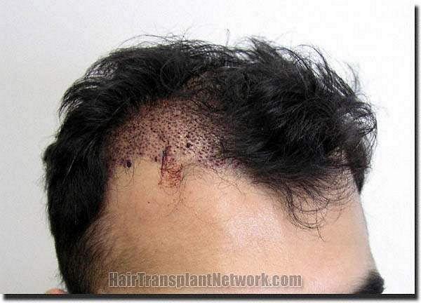 Hair restoration procedure results