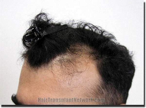 Hair restoration procedure results