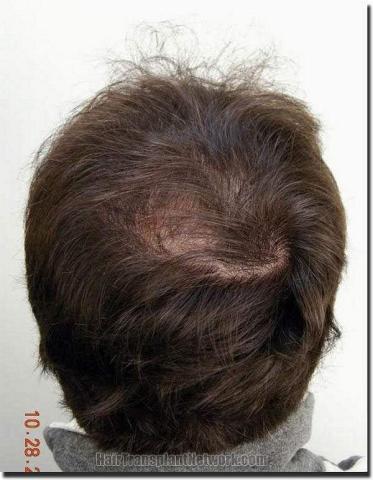 Hair restoration procedure results