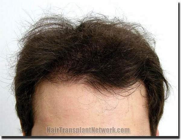 Hair restoration procedure results