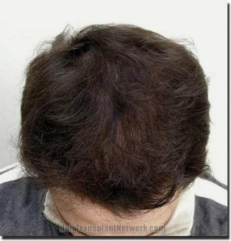 Hair restoration procedure results