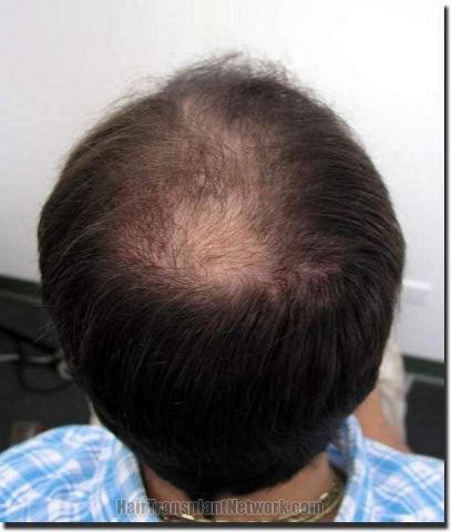 Hair restoration procedure results