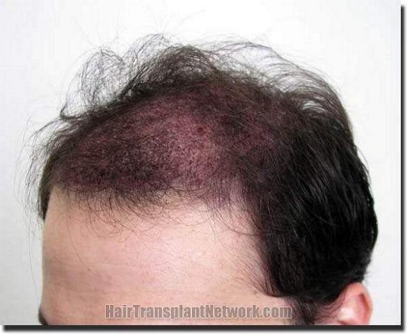 Hair restoration procedure results