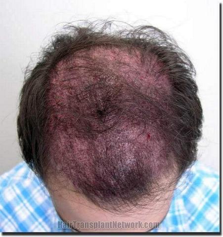 Hair restoration procedure results