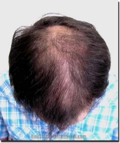 Hair restoration procedure results