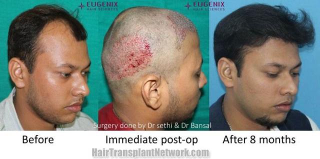 Hair transplantation procedure before and after results