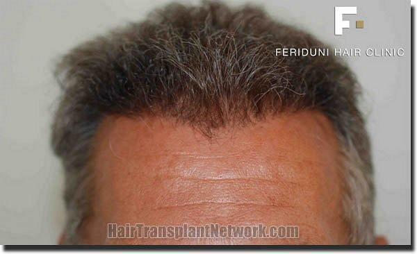 Hair restoration procedure results