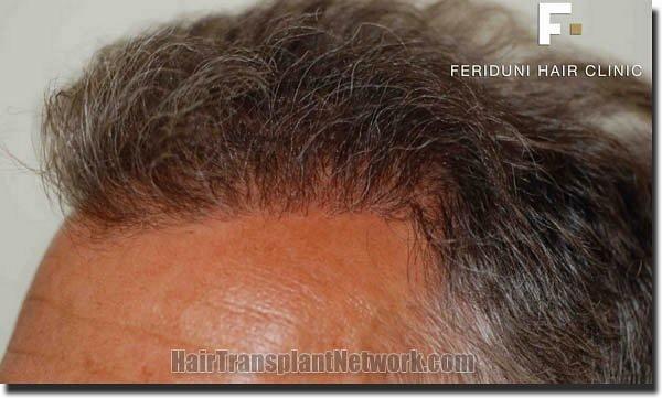 Hair restoration procedure results