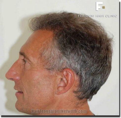 Hair restoration procedure results