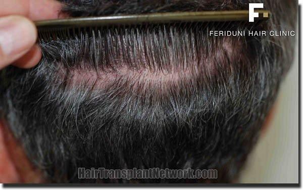 Hair restoration procedure results