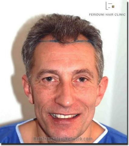 Hair restoration procedure results