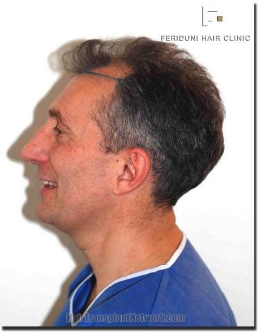 Hair restoration procedure results