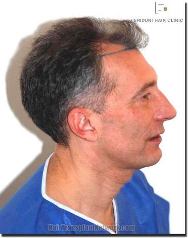 Hair restoration procedure results