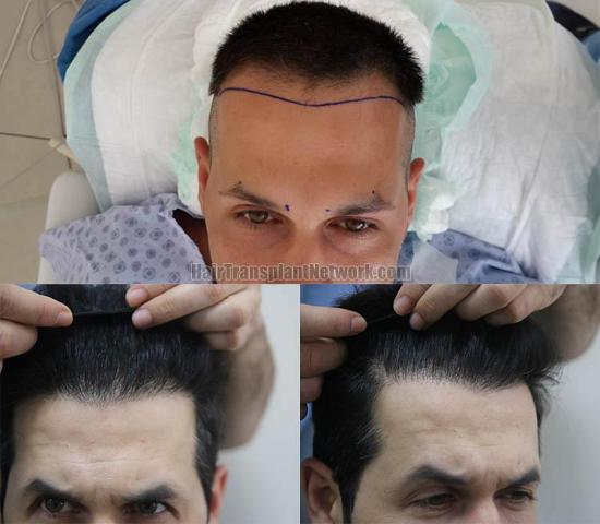 Hair restoration procedure before and after results