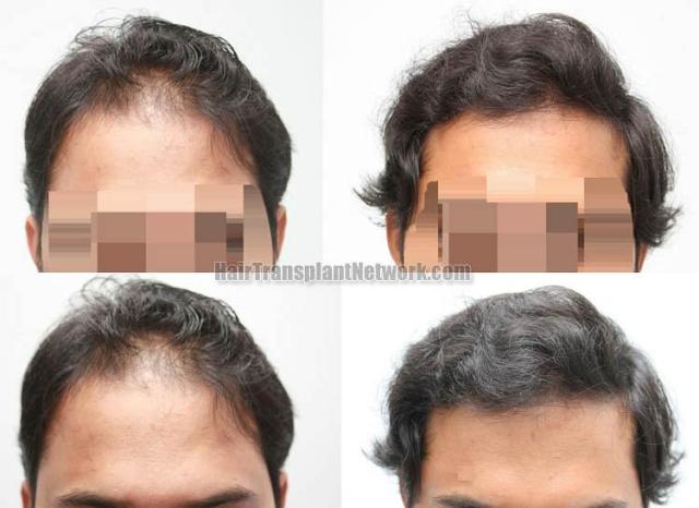 Hair restoration procedure before and after results