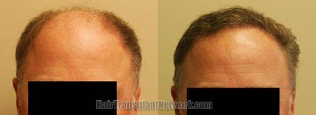 Hair restoration procedure before and after results