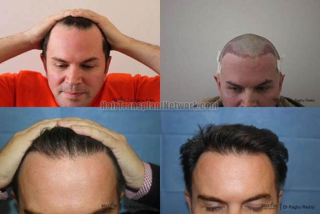 Hair restoration procedure before and after results