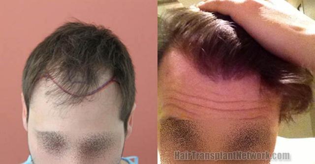 Hair transplantation surgery before and after photos